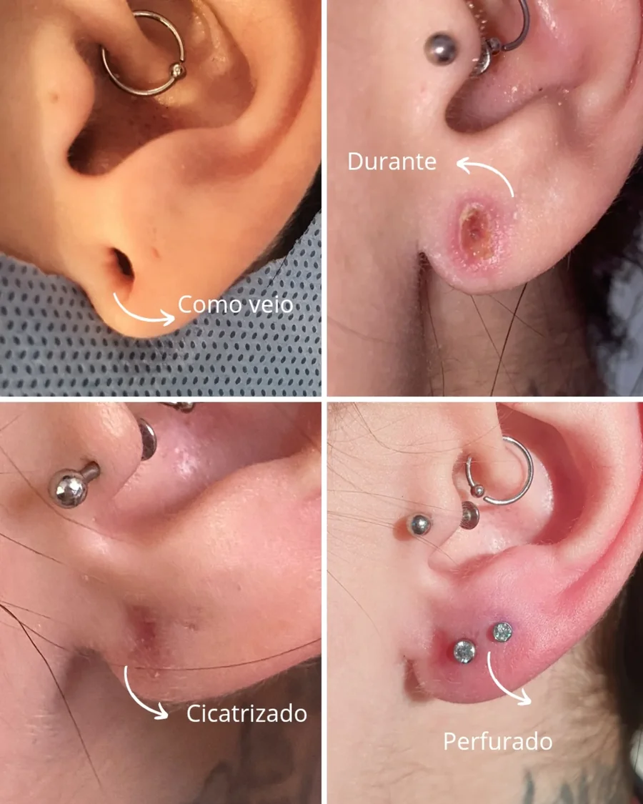 Lobuloplastia Não Cirúrgica